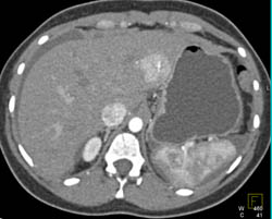 Focal Nodular Hyperplasia (FNH) - CTisus CT Scan