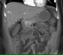 Hemangioma - CTisus CT Scan