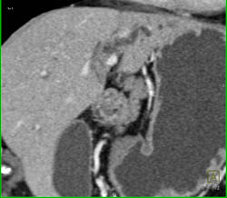 Common Bile Duct (CBD) Tumor - CTisus CT Scan