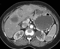 GIST Tumor With Liver Mestastases - CTisus CT Scan