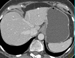 Subtle Hepatic Arteriovenous Malformation (AVM) - See 3D VRT - CTisus CT Scan