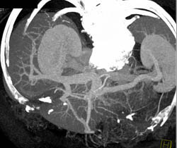 Cirrhosis With Varices and Recanalized Umbilical Vein - CTisus CT Scan