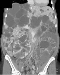 Polycystic Renal and Liver Disease - CTisus CT Scan