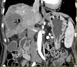 Liver Abscess and Infarct in Transplanted Liver - CTisus CT Scan