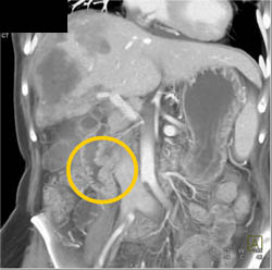 Ampullary Mass and Liver Abscess - CTisus CT Scan