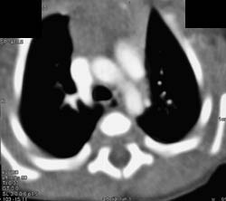 Perfusion Changes in Liver - CTisus CT Scan