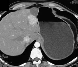 Focal Nodular Hyperplasia (FNH) - CTisus CT Scan