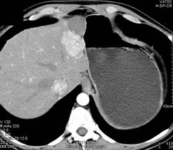 Focal Nodular Hyperplasia (FNH) - CTisus CT Scan