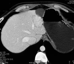 Focal Nodular Hyperplasia (FNH) - CTisus CT Scan