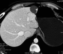 Focal Nodular Hyperplasia (FNH) - CTisus CT Scan