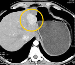 Focal Nodular Hyperplasia (FNH) - CTisus CT Scan