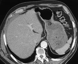 Peri-hepatic Bleed - CTisus CT Scan