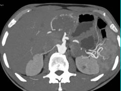 Hemangioma in Multiple Renderings - CTisus CT Scan