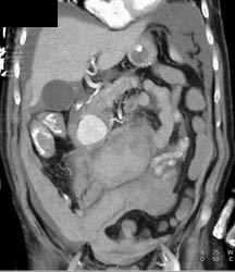 Hepatic Artery Aneurysm With Hemoperitoneum - CTisus CT Scan