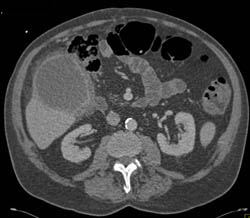 Acute Cholecystitis - CTisus CT Scan