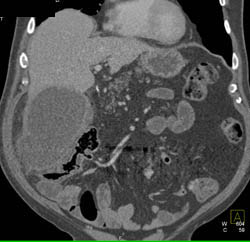 Acute Cholecystitis - CTisus CT Scan