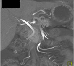 Stent in Common Bile Duct (CBD) in Patient With Cholangiocarcinoma With IVC Clot - CTisus CT Scan