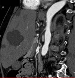 Huge Hepatic Cyst With Mass Effect - CTisus CT Scan