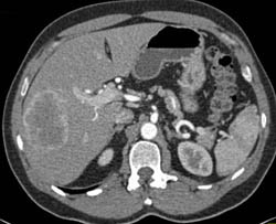 Hepatoma - CTisus CT Scan