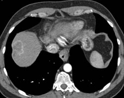 Hepatoma - CTisus CT Scan