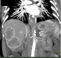 Hepatoma - CTisus CT Scan