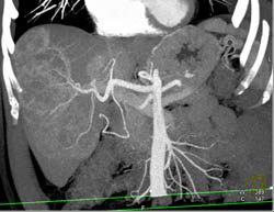 Hepatoma - CTisus CT Scan