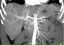 Hepatoma - CTisus CT Scan