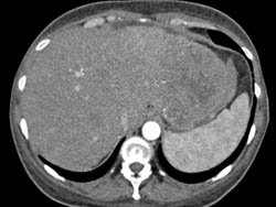 Hepatoma Best Seen Early on CTA - CTisus CT Scan