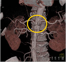 Seperate Origins Off Aorta for Hepatic and Splenic Arteries - CTisus CT Scan