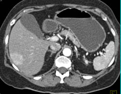 Focal Nodular Hyperplasia (FNH) - CTisus CT Scan