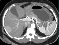 Focal Nodular Hyperplasia (FNH) - CTisus CT Scan