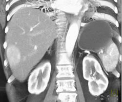 Focal Nodular Hyperplasia (FNH) - CTisus CT Scan