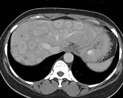 Unusual Metastatic Breast Cancer - CTisus CT Scan