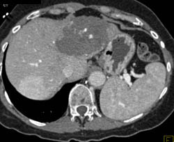 Focal Nodular Hyperplasia (FNH) and Hemangioma - CTisus CT Scan