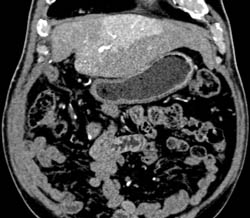 Perfusion Changes- Thad - CTisus CT Scan