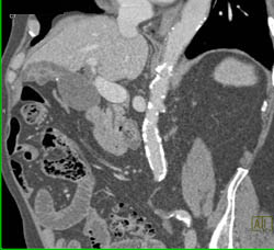 Polyps and Stones in Gallbladder - CTisus CT Scan