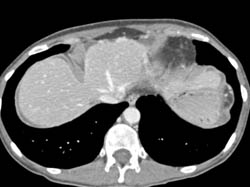 Gallbladder Cancer - CTisus CT Scan