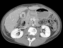 Gallbladder Cancer - CTisus CT Scan