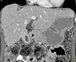 Gallbladder Cancer - CTisus CT Scan