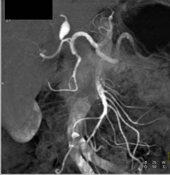 Hepatic Artery Aneurysm - CTisus CT Scan