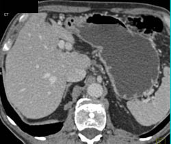 Hepatic Artery Aneurysm - CTisus CT Scan