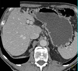 Hepatic Artery Aneurysm - CTisus CT Scan