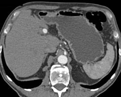 Hepatic Artery Aneurysm - CTisus CT Scan