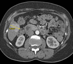 Focal Nodular Hyperplasia (FNH) - CTisus CT Scan