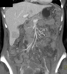 Focal Nodular Hyperplasia (FNH) - CTisus CT Scan