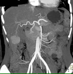 Focal Nodular Hyperplasia (FNH) - CTisus CT Scan