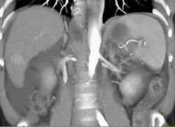 Focal Nodular Hyperplasia (FNH) - CTisus CT Scan