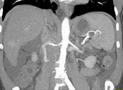 Focal Nodular Hyperplasia (FNH) - CTisus CT Scan