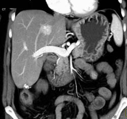 Hepatic Adenoma - CTisus CT Scan