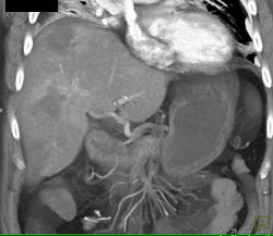 Hepatoma With Radiofrequency Ablation (RFA) and Residual Tumor - CTisus CT Scan